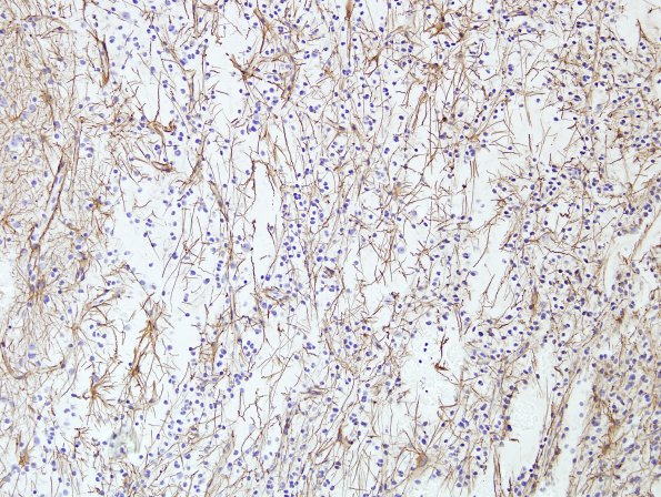 20C1 DNET (Case 20) GFAP 2.jpg