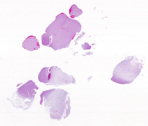 23A1 DNET (Case 23) H&E whole mount