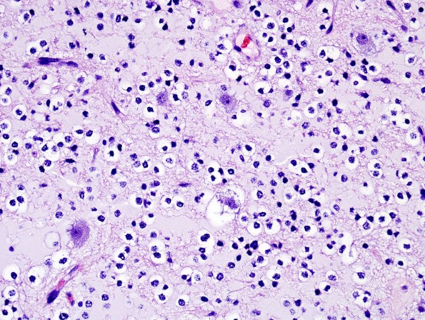 23A4 DNET (Case 23) H&E 6