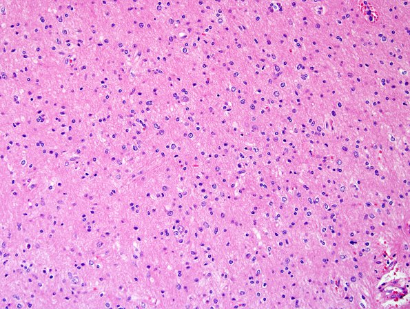 24B3 DNET (Case 24) CD34 positive area H&E 4.jpg