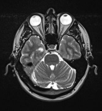 25A3 DNET (Case 25) T2W - Copy