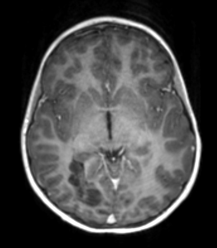 29A1 T1wC (Case 29) a