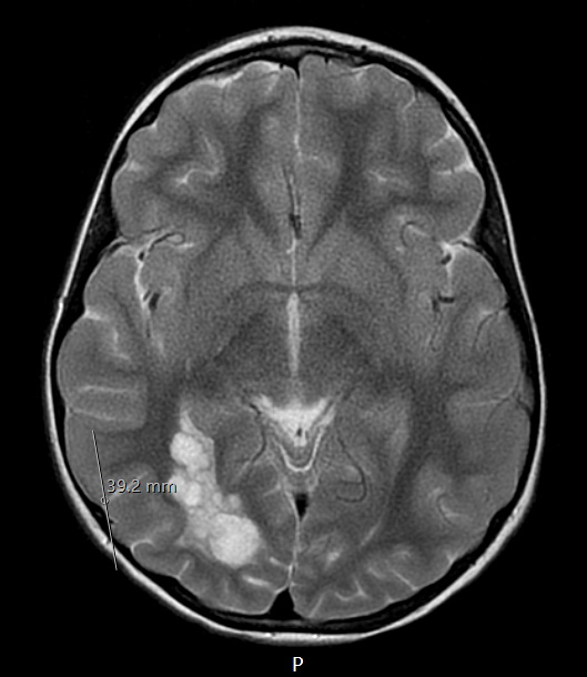 29A2 DNET & Heterotopia (Case 29) T2 propeller a