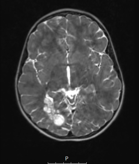29A3 DNET & Heterotopia (Case 29) T2wC 3a
