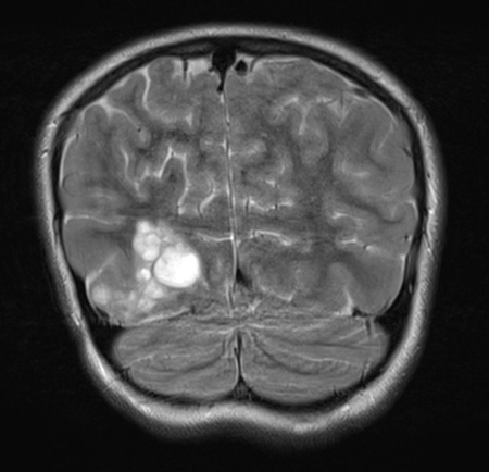 29A4 DNET & Heterotopia (Case 29) T2wC A