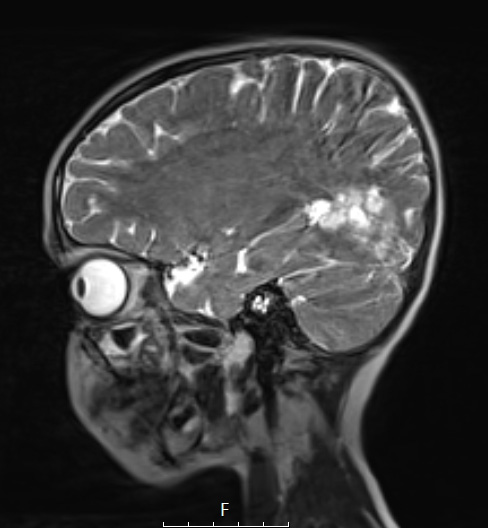 29A5 DNET & Heterotopia (Case 29) T2wC 2 A