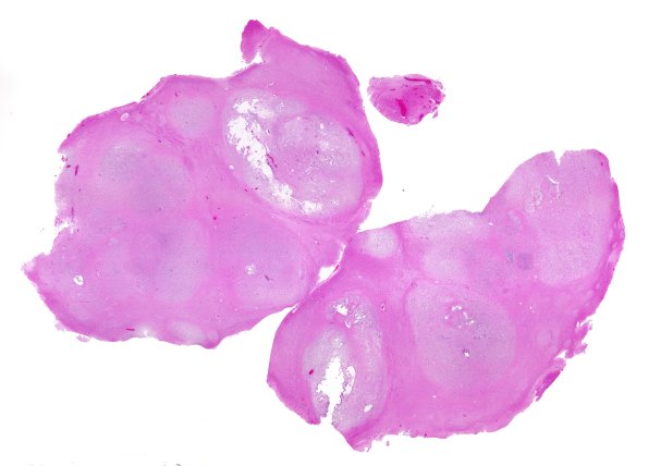 29B1 DNET & Heterotopia (Case 29) H&E WM