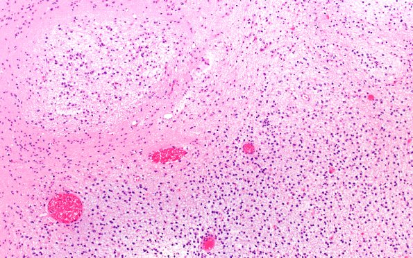 29B2 DNET & Heterotopia (Case 29) H&E 20X