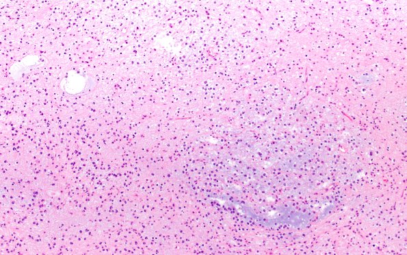 29B3 DNET & Heterotopia (Case 29) H&E 10X 2