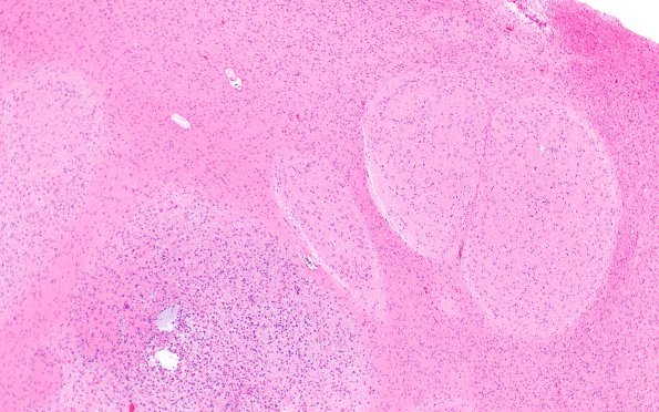 29B5 DNET & Heterotopia (Case 29) H&E 4X