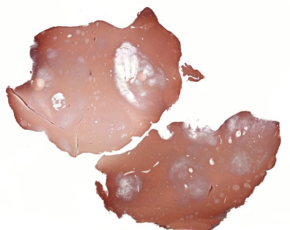 29C1 DNET & Heterotopia (Case 29) GFAP WM