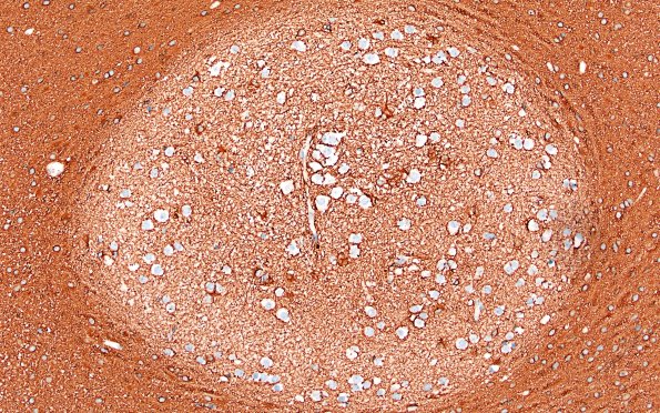 29C2 DNET & Heterotopia (Case 29) GFAP 20X nodule