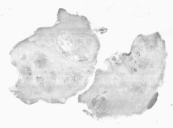 29D1 DNET & Heterotopia (Case 29) Olig2 WMA