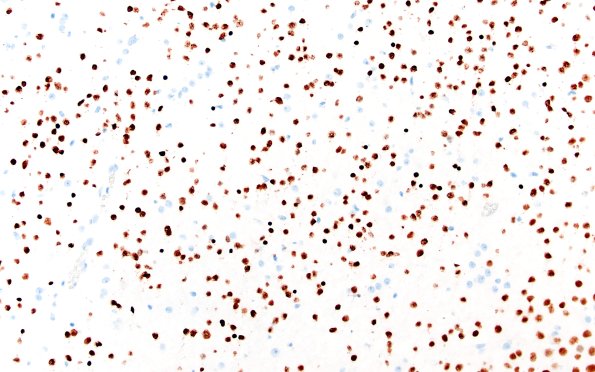 29D2 DNET & Heterotopia (Case 29) Olig2 20X 2