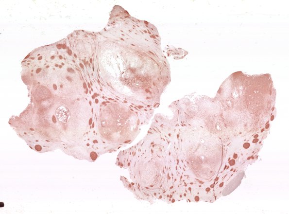 29E1 DNET & Heterotopia (Case 29) SYN WM