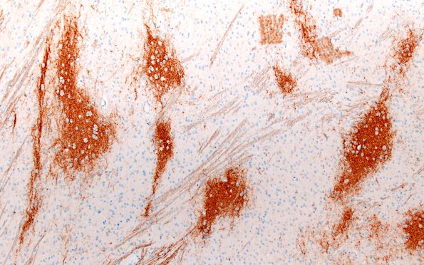 29E2 DNET & Heterotopia (Case 29) SYN 10X