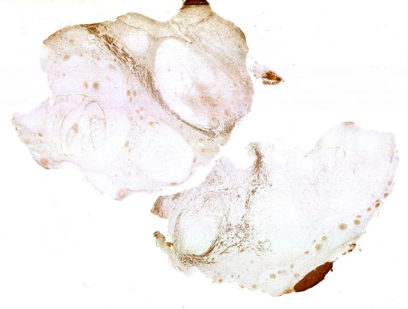 29F1 DNET & Heterotopia (Case 29) NF WM