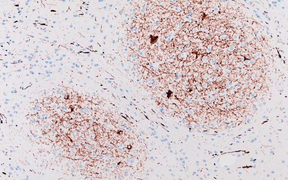 29F2 DNET & Heterotopia (Case 29) NF 20X nodule