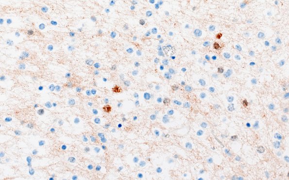 29G2 DNET & Heterotopia (Case 29) NeuN 40X 2