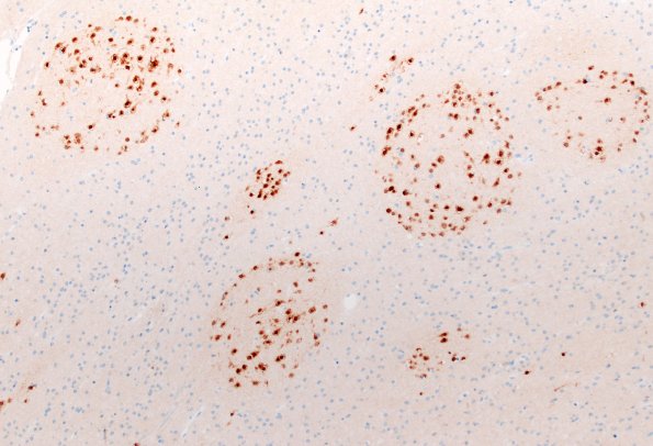 29G3 DNET & Heterotopia (Case 29) NeuN 10X 2