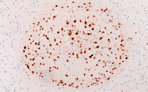 29G4 DNET & Heterotopia (Case 29) NeuN 20X