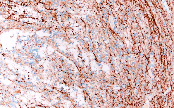 2D4 DNET (Case 2) Synaptophysin 1