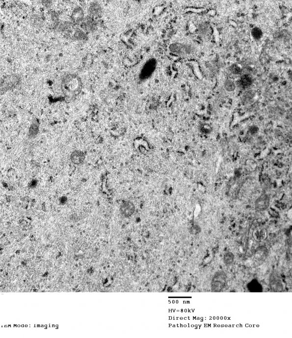 1H5 DIG (Case 1) EM 021 - Copy