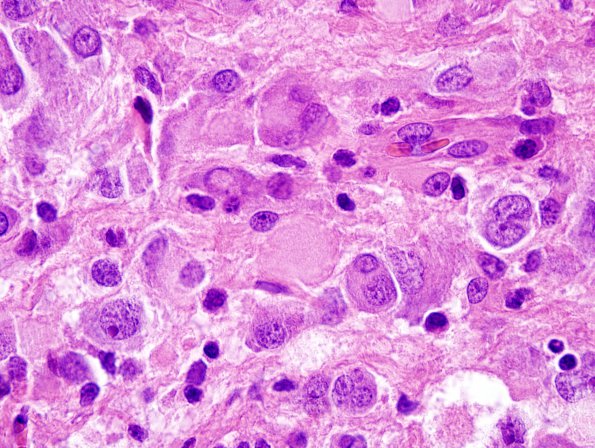 2C8 DIG (Case 2) H&E 100X 1