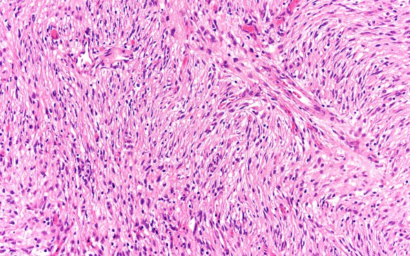 4A4 DIG (Case 4) H&E 20X