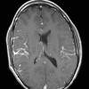 1A1 Diffuse leptomeningeal glioneuronal tumor (Case 1) T1W 1