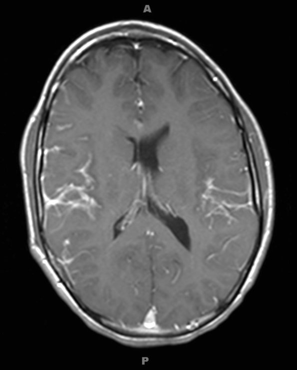 1A1 Diffuse leptomeningeal glioneuronal tumor (Case 1) T1W 1