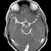 1A2 Diffuse leptomeningeal glioneuronal tumor (Case 1) T1W 2