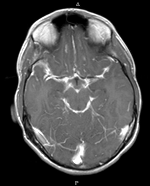 1A2 Diffuse leptomeningeal glioneuronal tumor (Case 1) T1W 2