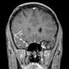 1A3 Diffuse leptomeningeal glioneuronal tumor (Case 1) T1W 4