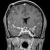 1A4 Diffuse leptomeningeal glioneuronal tumor (Case 1) T1W 3