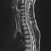 1A5 Diffuse leptomeningeal glioneuronal tumor (Case 1) T2 1