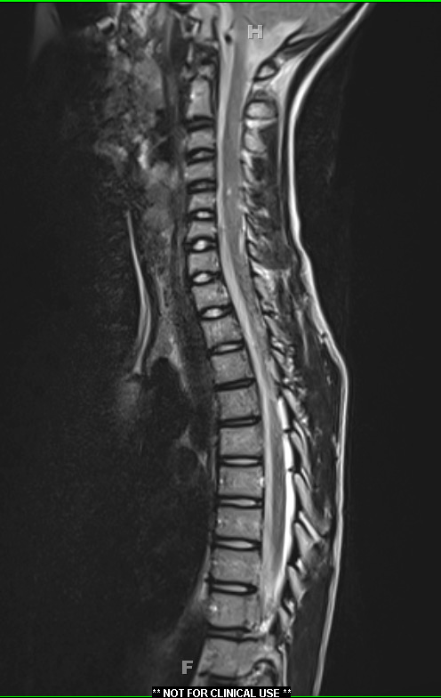 1A5 Diffuse leptomeningeal glioneuronal tumor (Case 1) T2 1