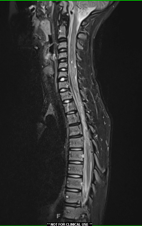 1A6 Diffuse leptomeningeal glioneuronal tumor (Case 1) T2 STIR 2