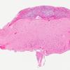 1B1 Diffuse leptomeningeal glioneuronal tumor (Case 1) H&E 4X