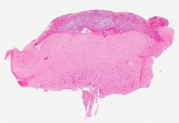 1B1 Diffuse leptomeningeal glioneuronal tumor (Case 1) H&E 4X