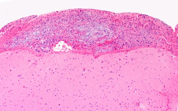 1B2 Diffuse leptomeningeal glioneuronal tumor (Case 1) H&E 10X