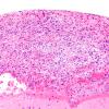 1B3 Diffuse leptomeningeal glioneuronal tumor (Case 1) H&E 20X