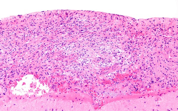 1B3 Diffuse leptomeningeal glioneuronal tumor (Case 1) H&E 20X