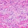 1B4 Diffuse leptomeningeal glioneuronal tumor (Case 1) H&E 40X 1