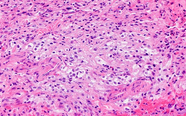 1B4 Diffuse leptomeningeal glioneuronal tumor (Case 1) H&E 40X 1