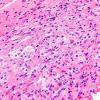 1B5 Diffuse leptomeningeal glioneuronal tumor (Case 1) H&E 40X 2