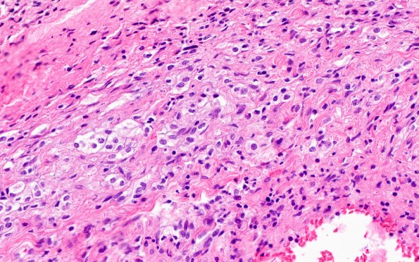 1B5 Diffuse leptomeningeal glioneuronal tumor (Case 1) H&E 40X 2