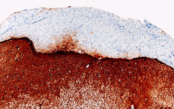 1C2 Diffuse leptomeningeal glioneuronal tumor (Case 1) GFAP 10X 1