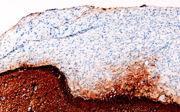 1C3 Diffuse leptomeningeal glioneuronal tumor (Case 1) GFAP 20X 1