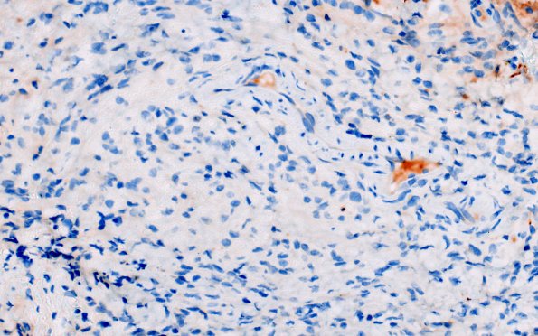 1C5 Diffuse leptomeningeal glioneuronal tumor (Case 1) GFAP 40X 1